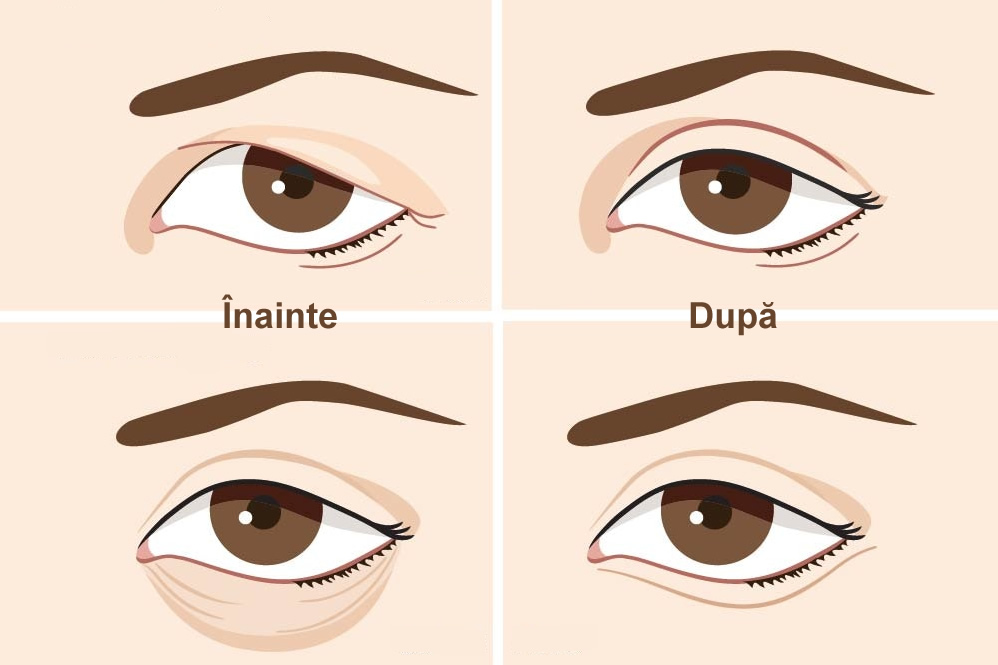 Blefaroplastie